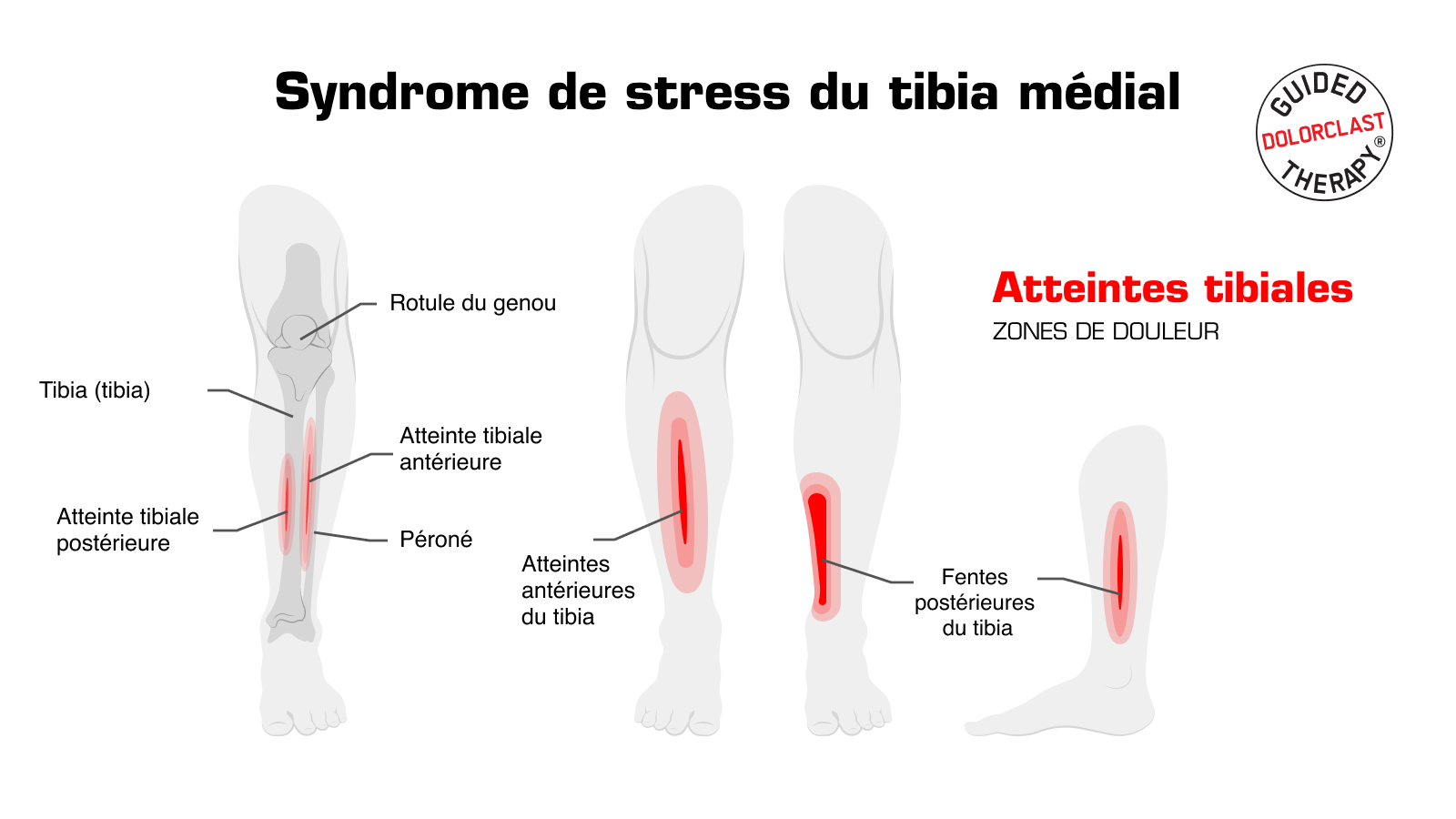 la-th-rapie-par-ondes-de-choc-comme-traitement-du-syndrome-du-stress-du